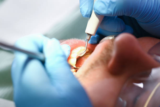 Best Emergency Wisdom Teeth Removal in Oberlin, OH