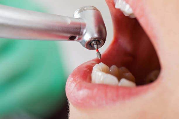 Best Emergency Tooth Extraction in Oberlin, OH